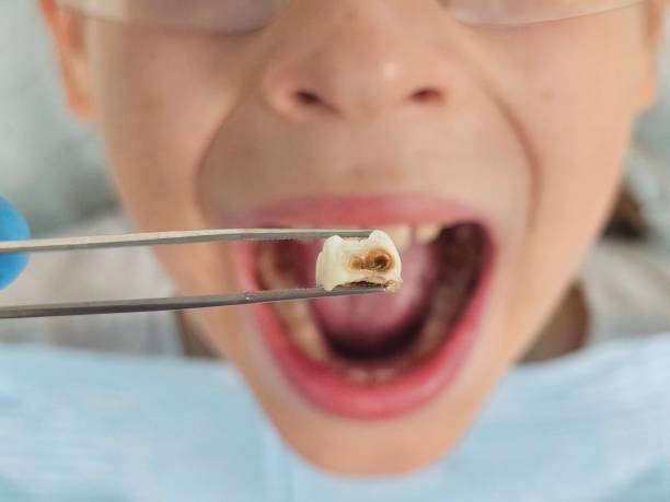 Best Emergency Broken Tooth Repair in Wichita Falls, TX
